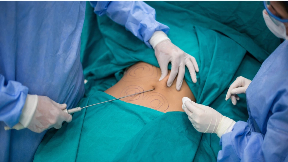 Liposuction—Tumescent & Laser Picture