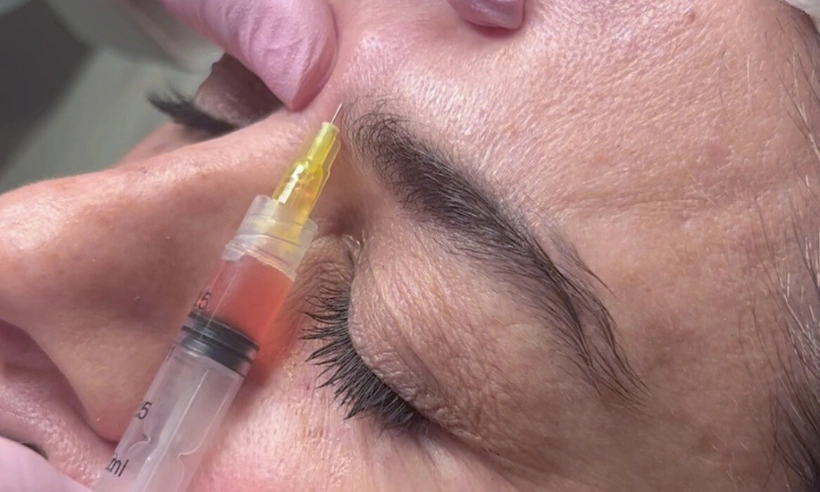 platelet-rich plasma prp photo gallery 2