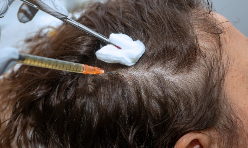 platelet-rich plasma prp photo gallery 4