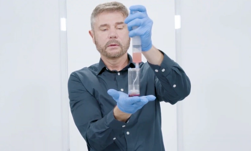 platelet-rich plasma prp photo gallery 7