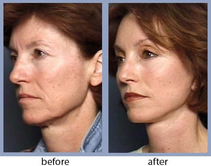 Advanced Injectables - before-after