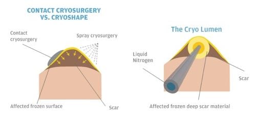 keloid graphic