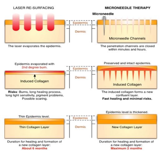 micro-needling