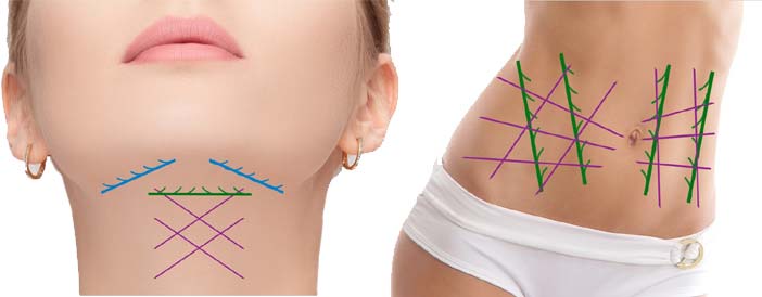 Chart showing placement and examples for body and face pdo thread placement