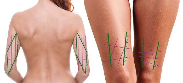 additional examples of body thread lift procedures using barbed and smooth pdo sutures
