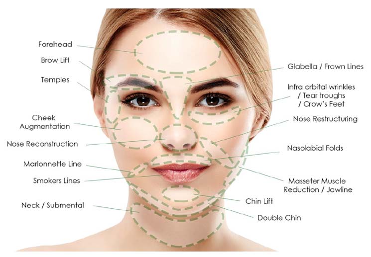 Chart showing Possible facial areas for thread lift procedures
