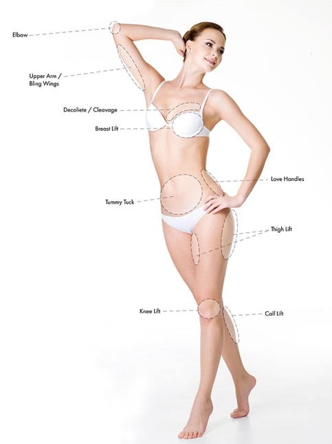 Chart illustrating possible thread lift suture placement for other body areas