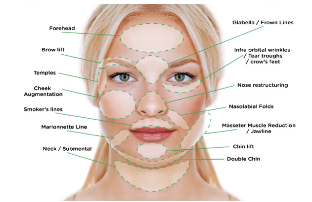 Thread lift areas